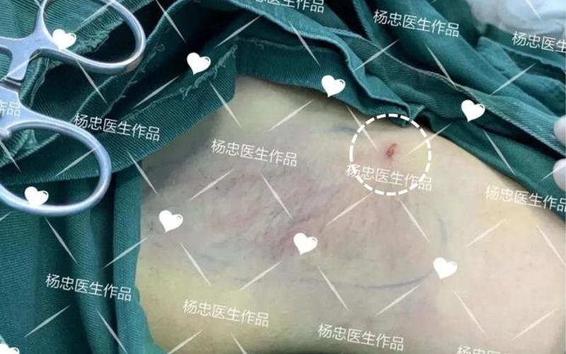 狐臭是微创的好还是全切的好(狐臭做微创效果好吗)