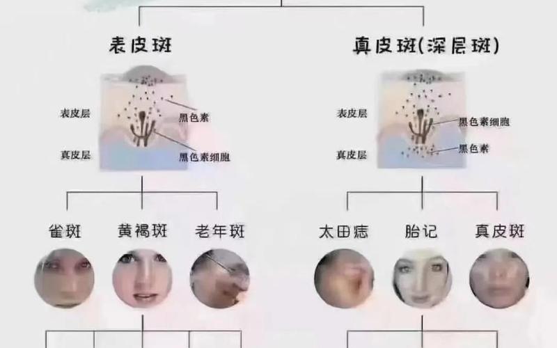 黄褐斑是真皮斑还是表皮斑(真皮斑的克星是什么)