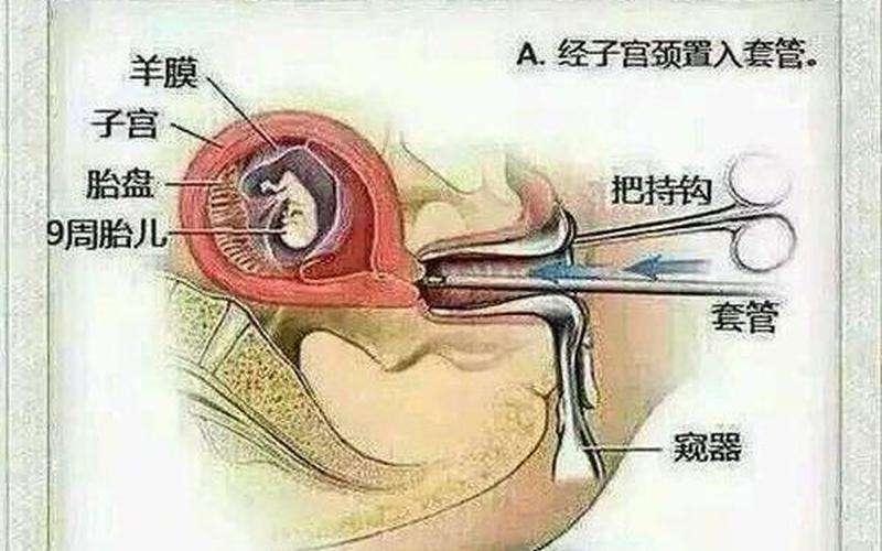 怀孕了是做人流好还是药流(6周人流好还是药流)